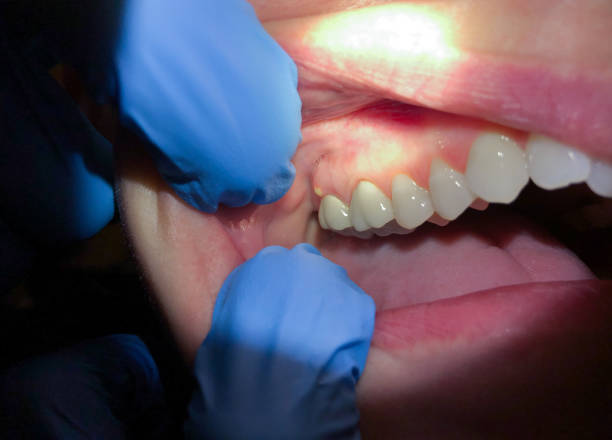 Best Dental Abscess Treatment in Sunland Park, NM